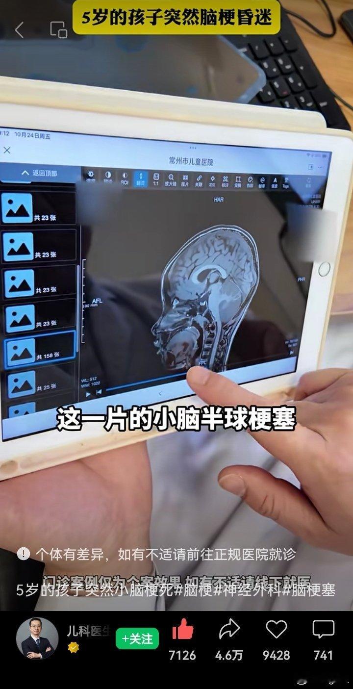 5岁的孩子突然小脑梗死以前这种现象很罕见的吧儿科医生真的不知道原因说句题外话：这