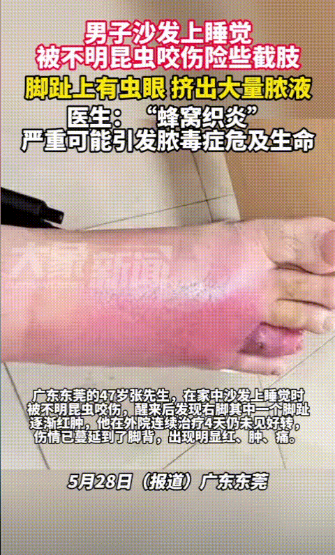 “太吓人了！”广东东莞，一47岁男子在沙发上睡了一觉后，发现自己的脚被不明昆虫咬