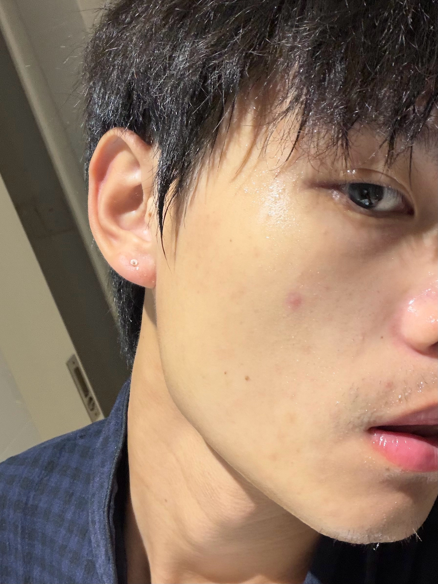 到了亚庇就爆痘。已经很久没长痘了，上次长痘还是在去年大四上学期 。。。。。。 