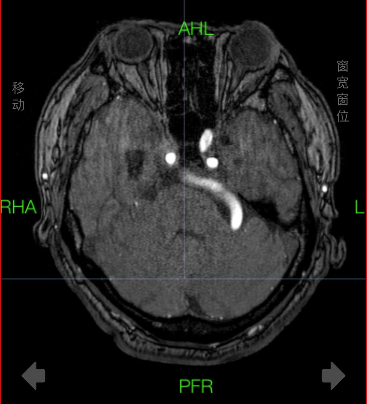 疼痛难忍。碰上这么一条“大蛇”（白色-椎基底动脉延长扩张）导致三叉神经痛，疼痛难忍，开颅风险较高，今日球囊手术顺利解决疼痛！
