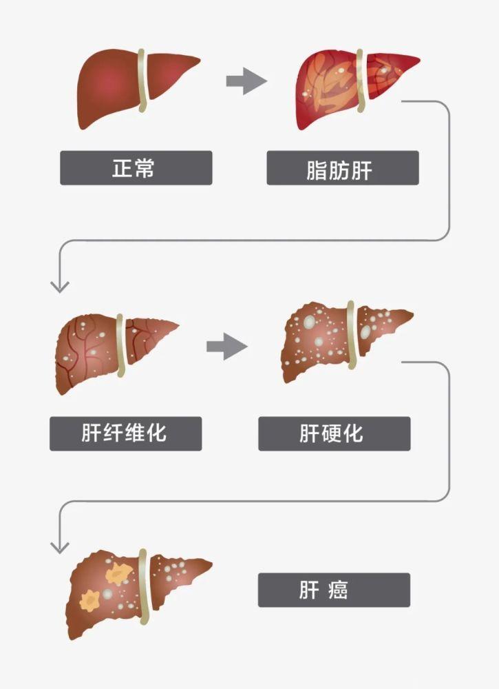 【脂肪肝与现代检查】#翆筱轩临证随笔#门诊一位患者在4月份查出重度脂肪肝，来我这