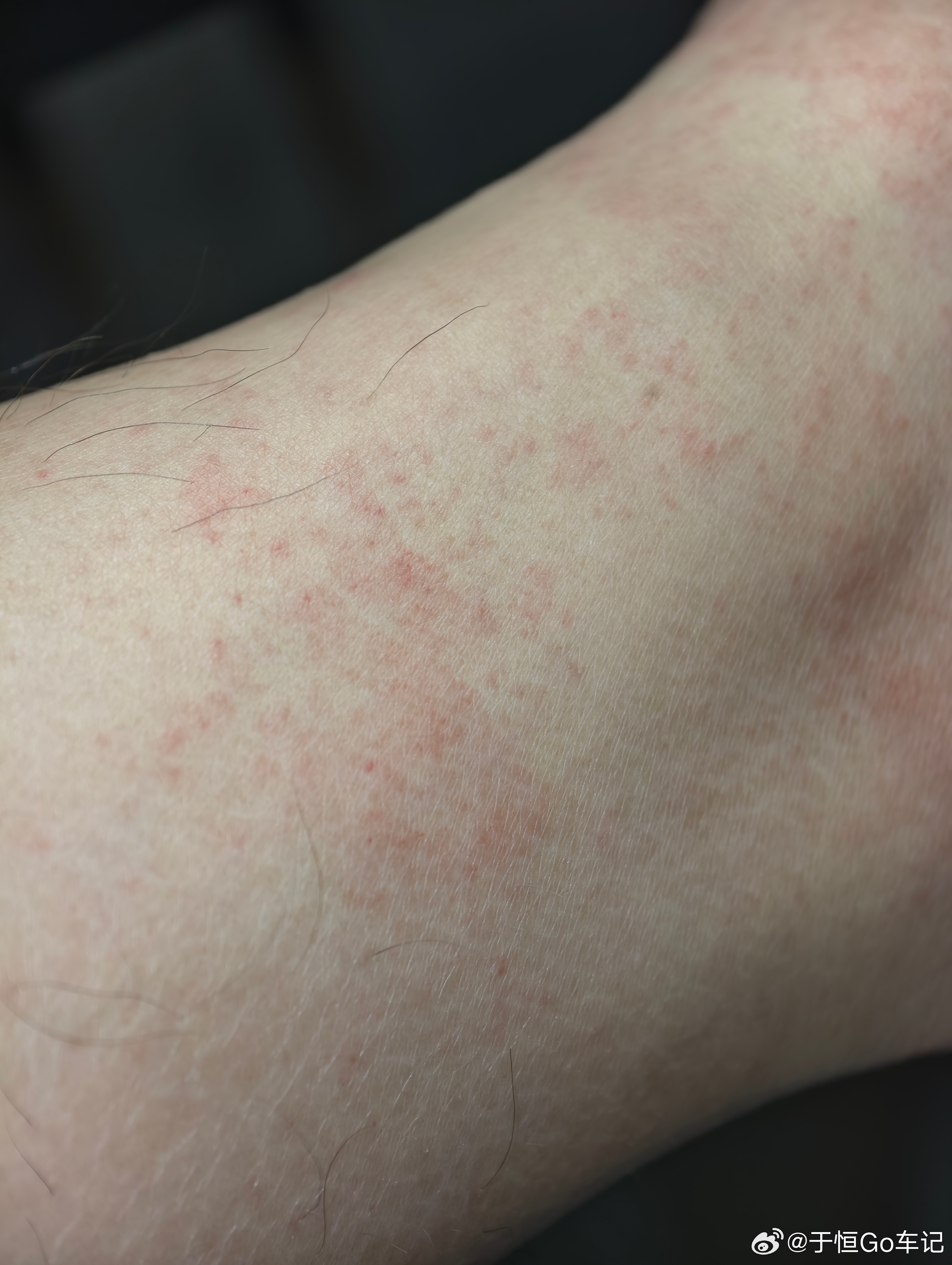 莫名其妙，昨天早上穿了一双袜子，送小孩上学回来后脚就开始很痒，看起来像过敏了，难