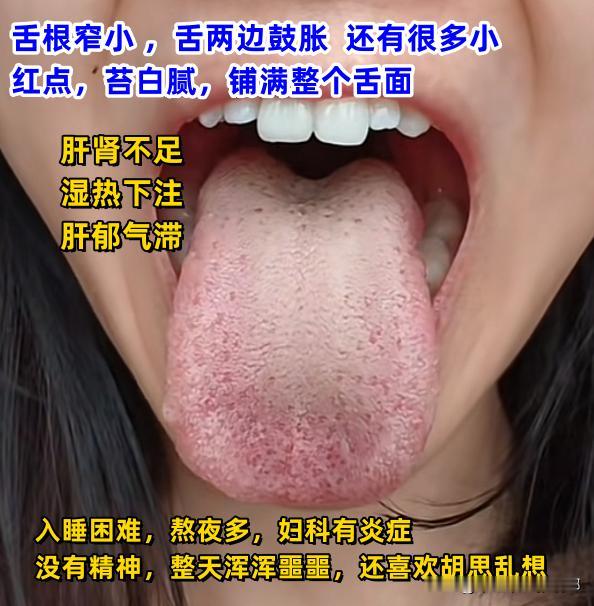 今日舌诊案例分析：肝肾不足、脾胃湿热、肝郁气滞[给力][给力][给力]

对照看