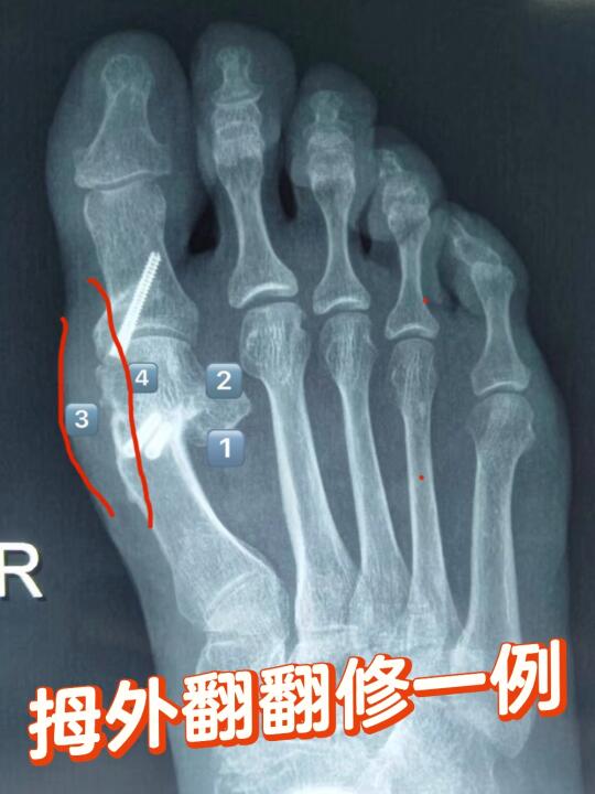 拇外翻翻修思路