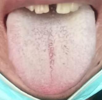 腰突总反复难除根？分清证型对症调养，才是关键






对于腰间盘突出该如何调