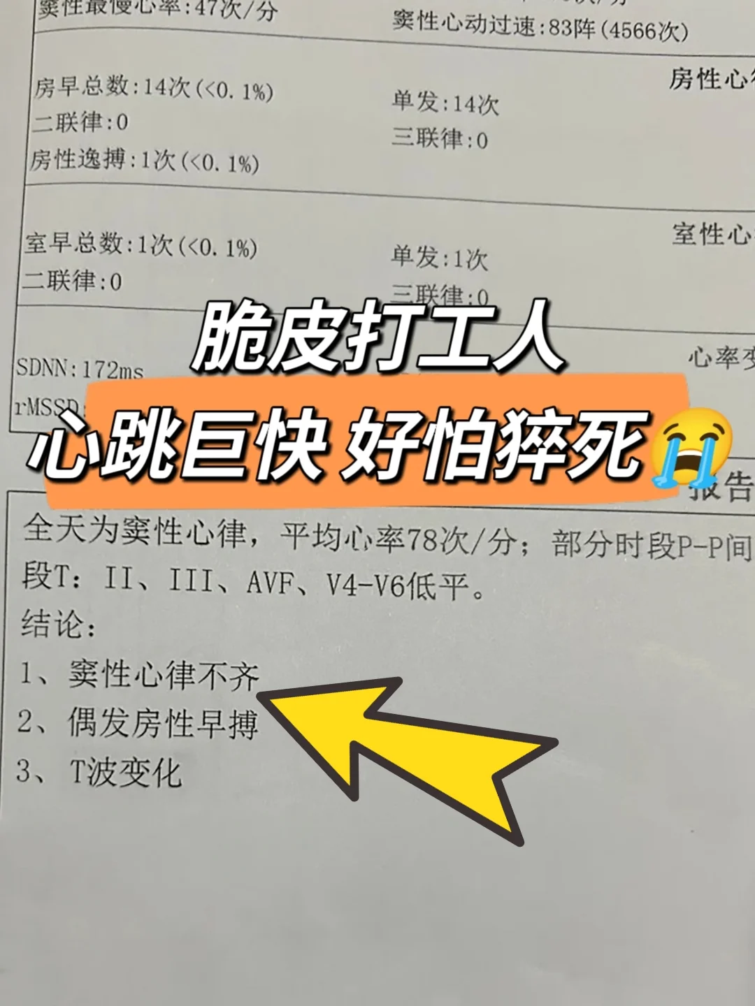 T波低平别轻视❗当心是心肌缺血