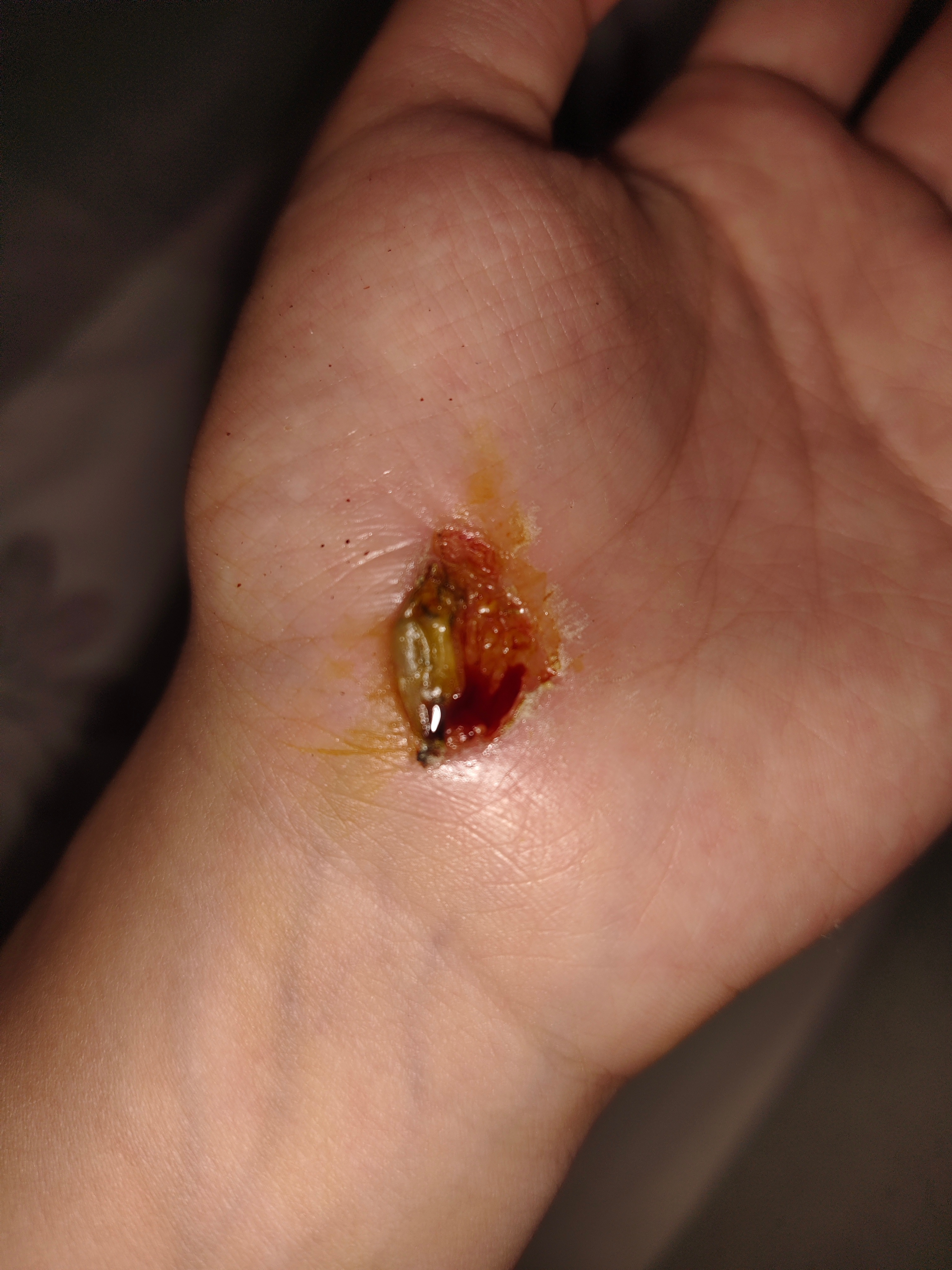 好疼呐 涂了点碘伏红肿热痛都有 