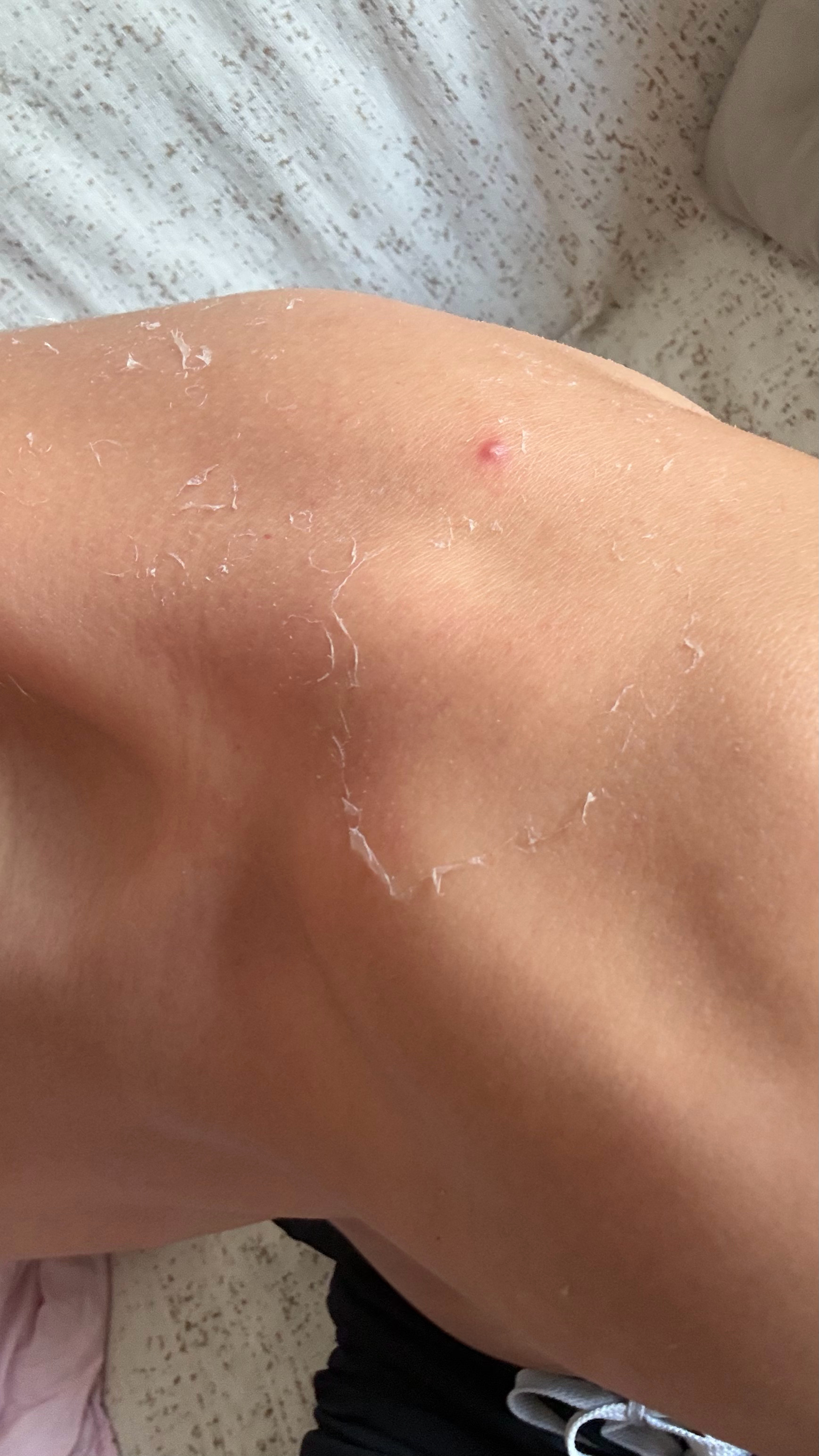 给哥们晒脱皮了