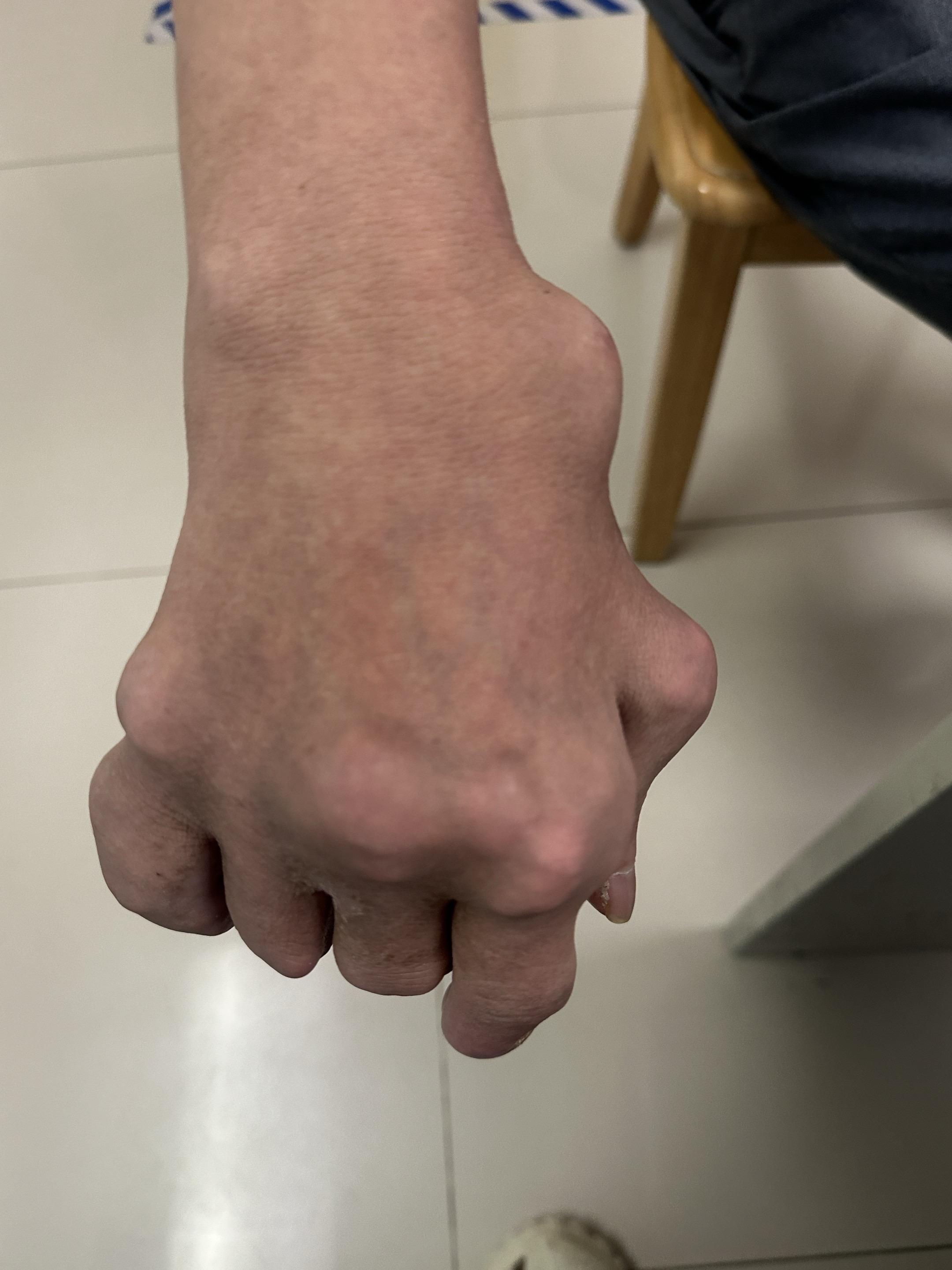 这个痛风够严重了吧。痛风太严重，都尿酸性肾病了痛风性肾病