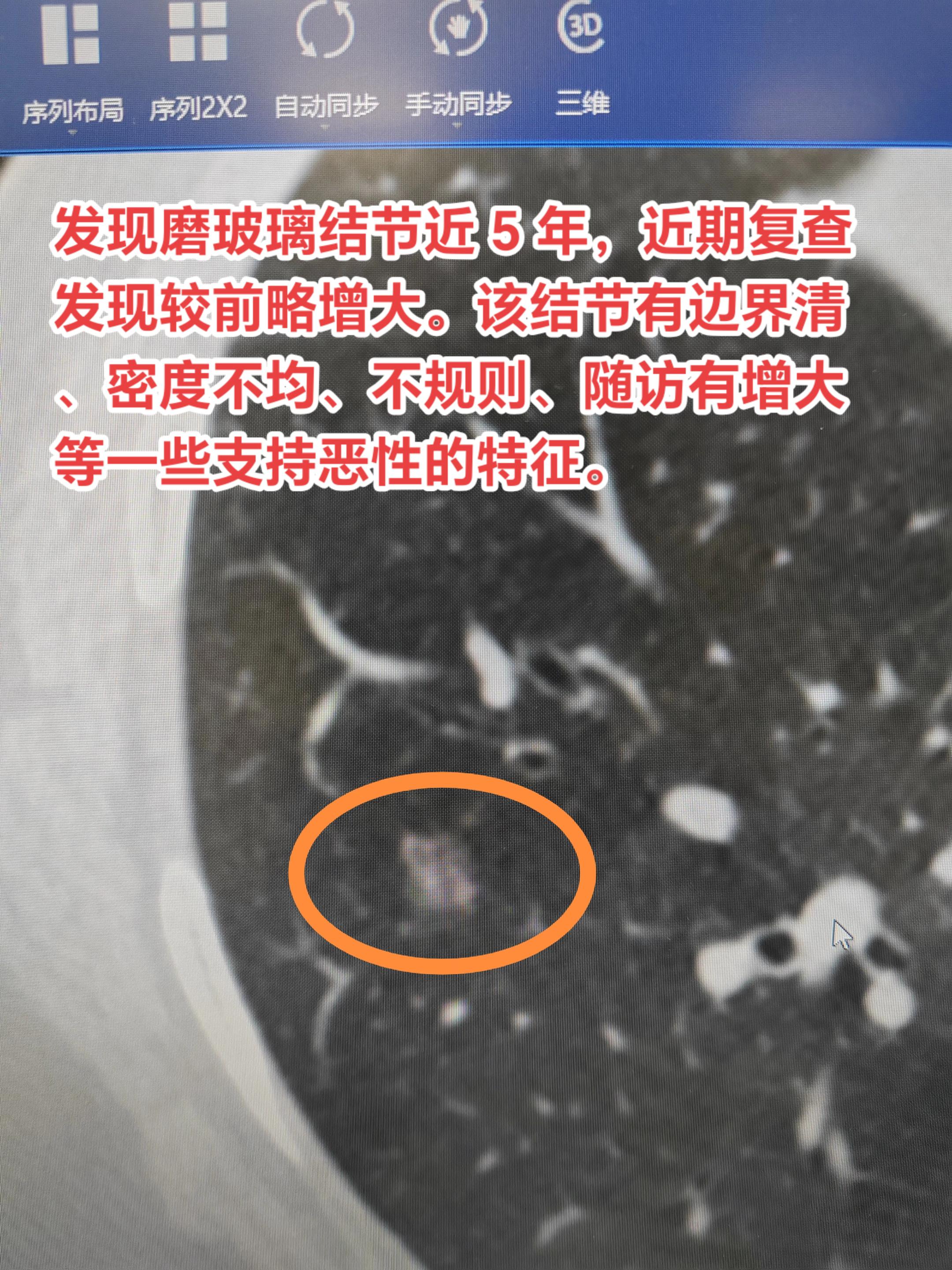随访中的磨玻结节增大该如何处理？发现磨玻璃结节近 5 年，近期复查发现...