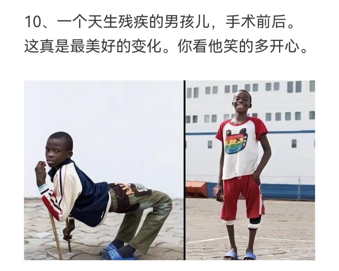 一个天生残疾的男孩儿，手术前后 这真是最美好的变化 你看他笑的多开心