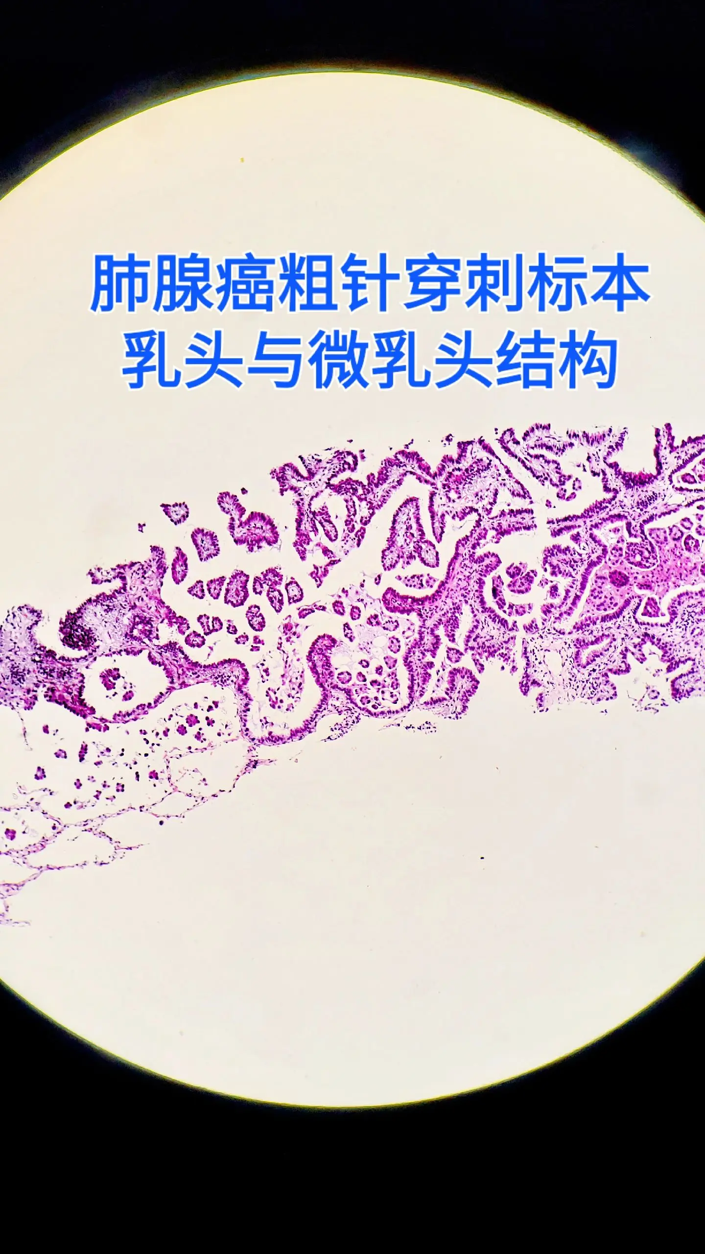 肺癌 粗针穿刺