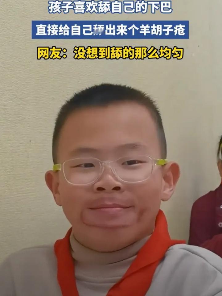 这还能笑得出来？浙江，一名男孩有个不太好的习惯，就是喜欢舔自己的下巴，可舔得多了