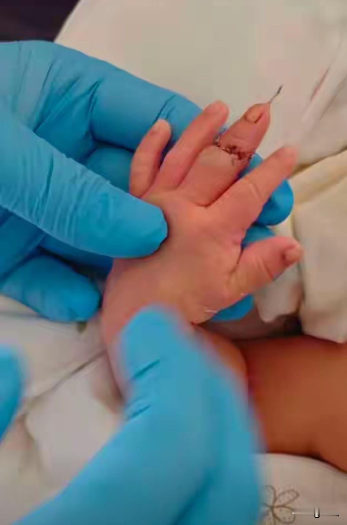 刚出生的儿子，剪脐带时被助产士一剪刀剪断了手指。

2025年12月25号，江苏