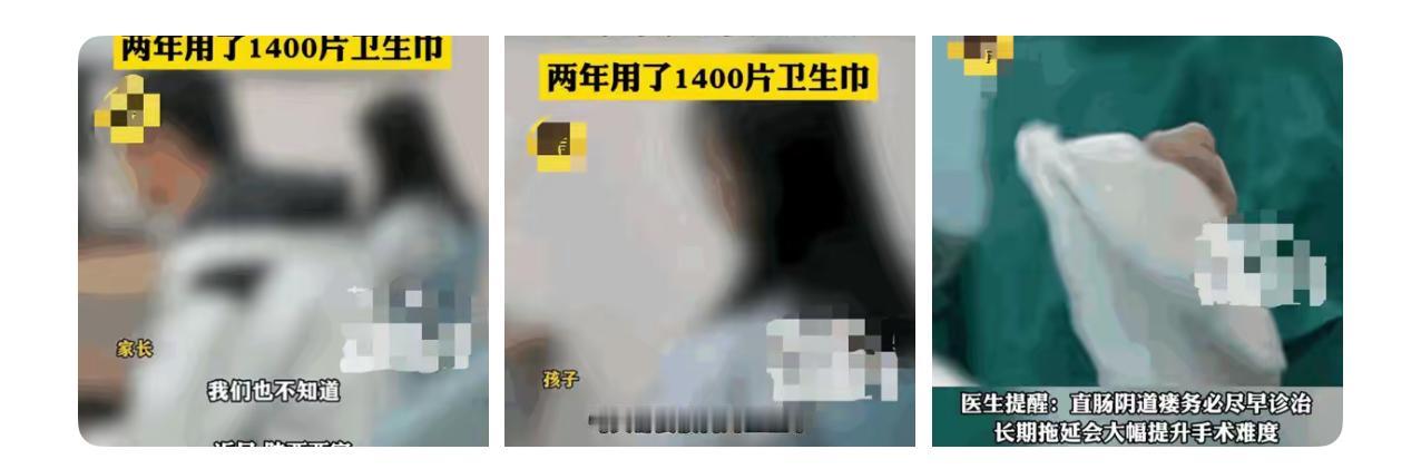 高二女孩直肠阴道瘘，忍痛两年用1400多片卫生巾才晕倒送医。

她的父母应该是很