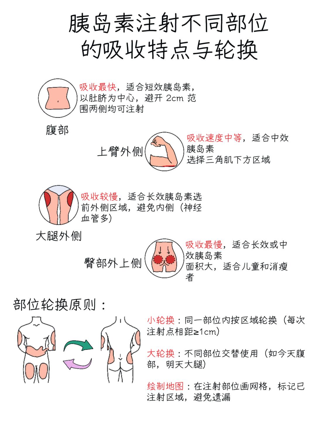 医学生笔记📝｜胰岛素注射部位与轮换