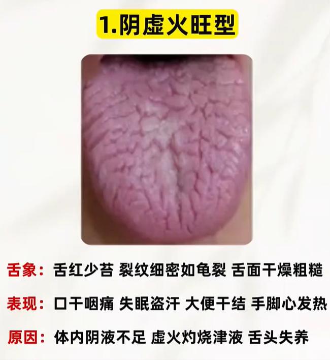 舌面布满裂纹分 4 类，阴虚火旺、胃火盛、气血虚、肾精亏，对症调养少踩坑
