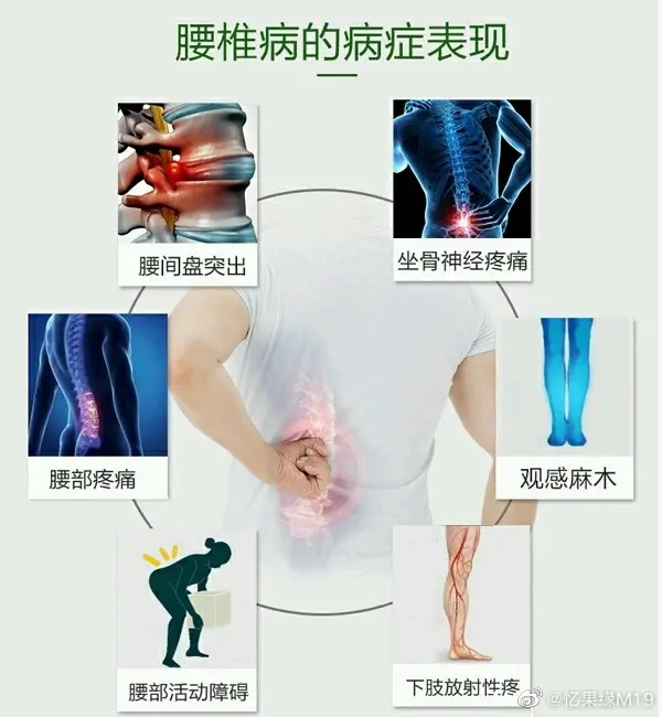 腰突出现4种情况，千万别硬扛着了1、腰椎局部的疼痛特别是在转腰、弯腰、扭腰的时候