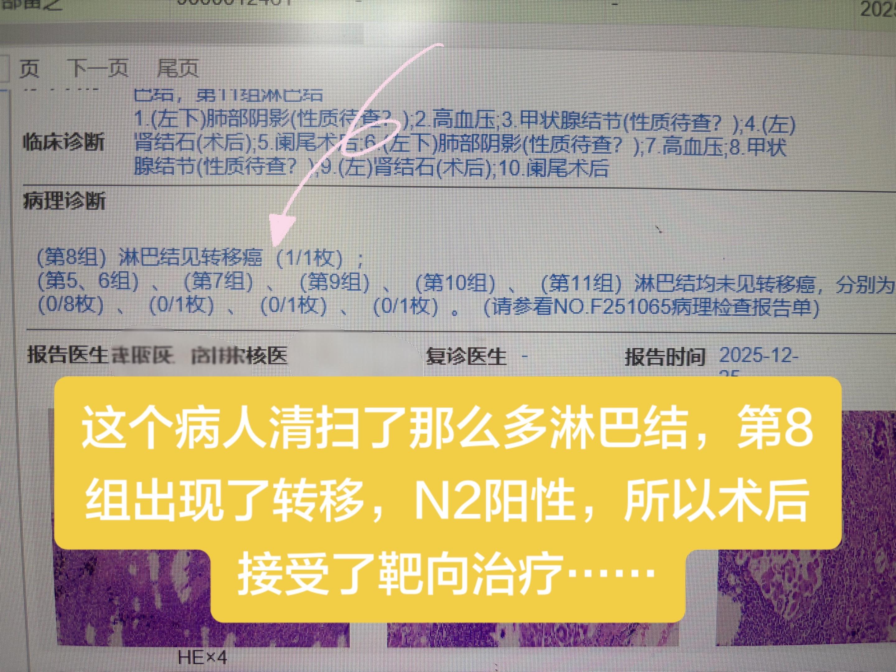 这个病人清扫了那么多淋巴结，第8组出现了转移，N2阳性，所以术后接受了...