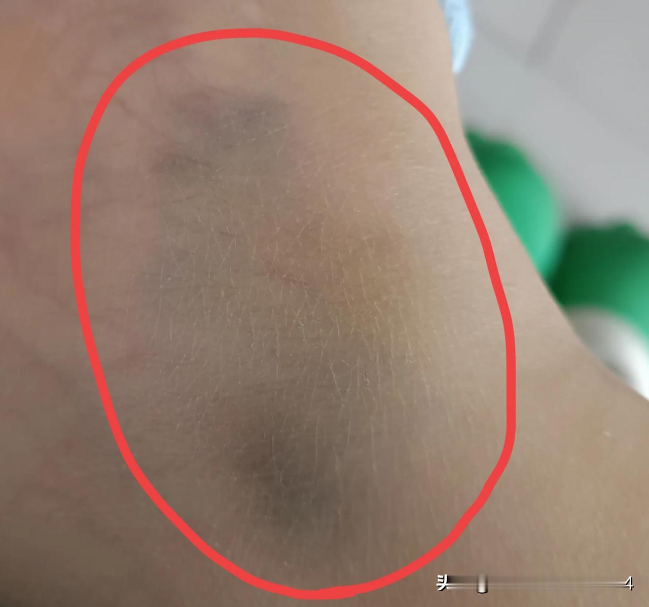 人到中年，发现自己好脆皮啊！上个星期脚脖子碰着桌子腿，当时疼了下，就没管它。谁知