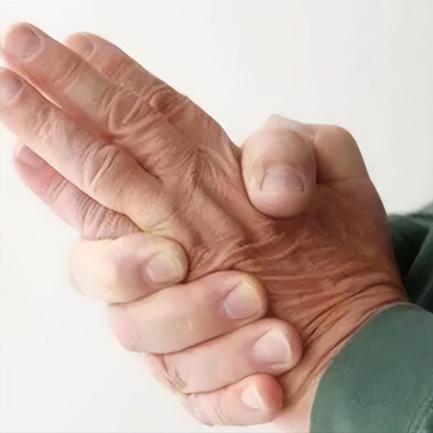 脑梗上肢恢复慢，原因竟然是这个！

很多脑梗患者和家属都有一个共同的困惑：腿已经