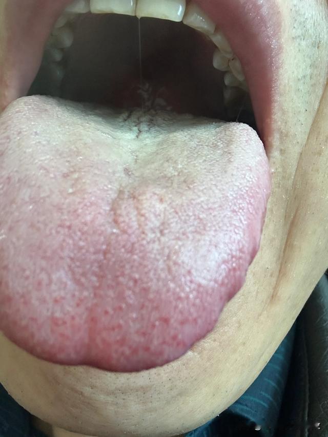 舌苔又厚又腻，偏偏你还要补肾，那你是在玩火[狗头][狗头][狗头]
这大哥，舌中