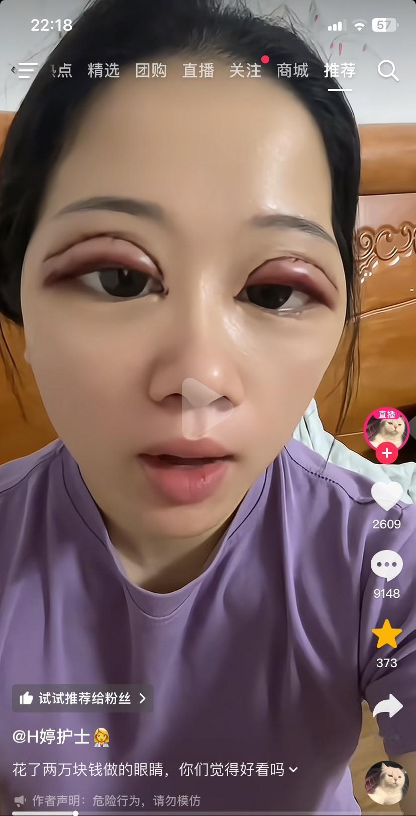 广西女子花两万块做双眼皮，问大家好看吗？他开直播，网友评论说，做的太浅了，多割几