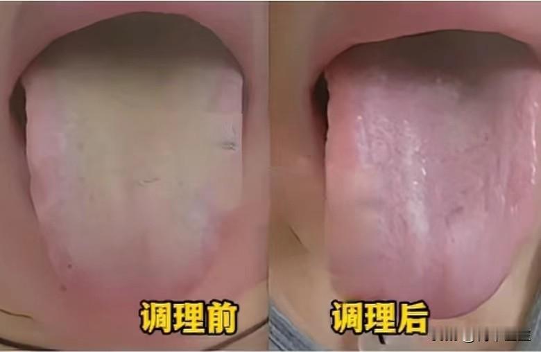 只用十天，患者舌象大变样。舌诊真实案例分享：

这位病人在经过十天的调理之后，我