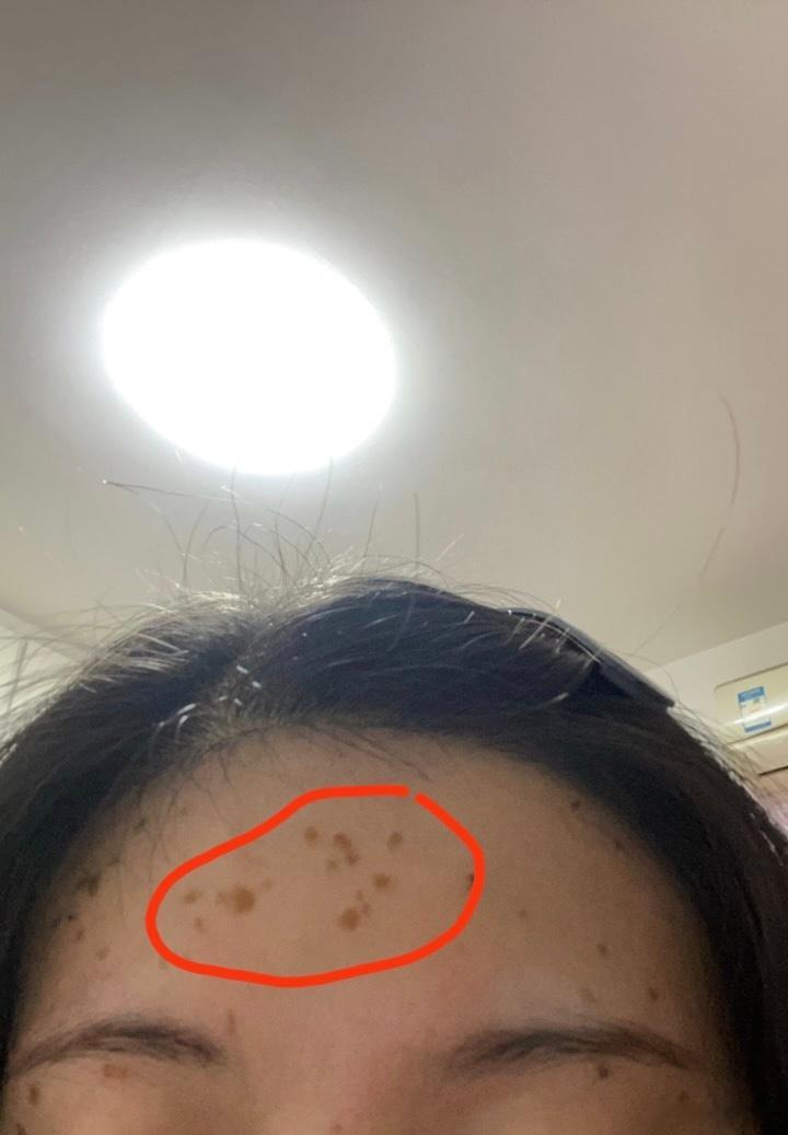 扁平疣的特效方扁平疣是HPV感染，就是人体多长出来的赘肉，中医认为汗出当风，为湿