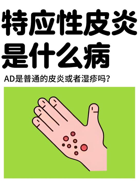 特应性皮炎是什么病？
