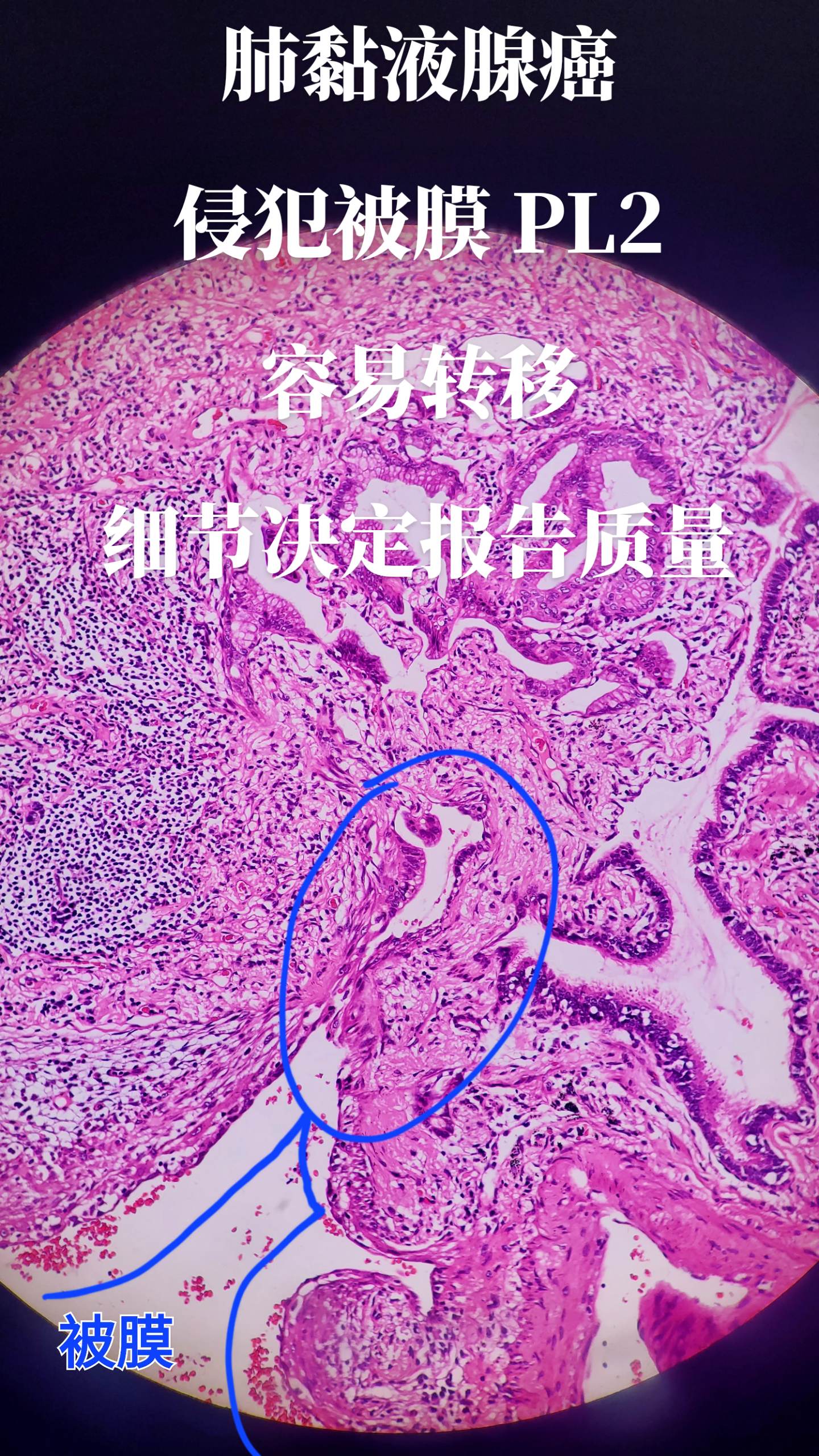 肺腺癌侵犯被膜