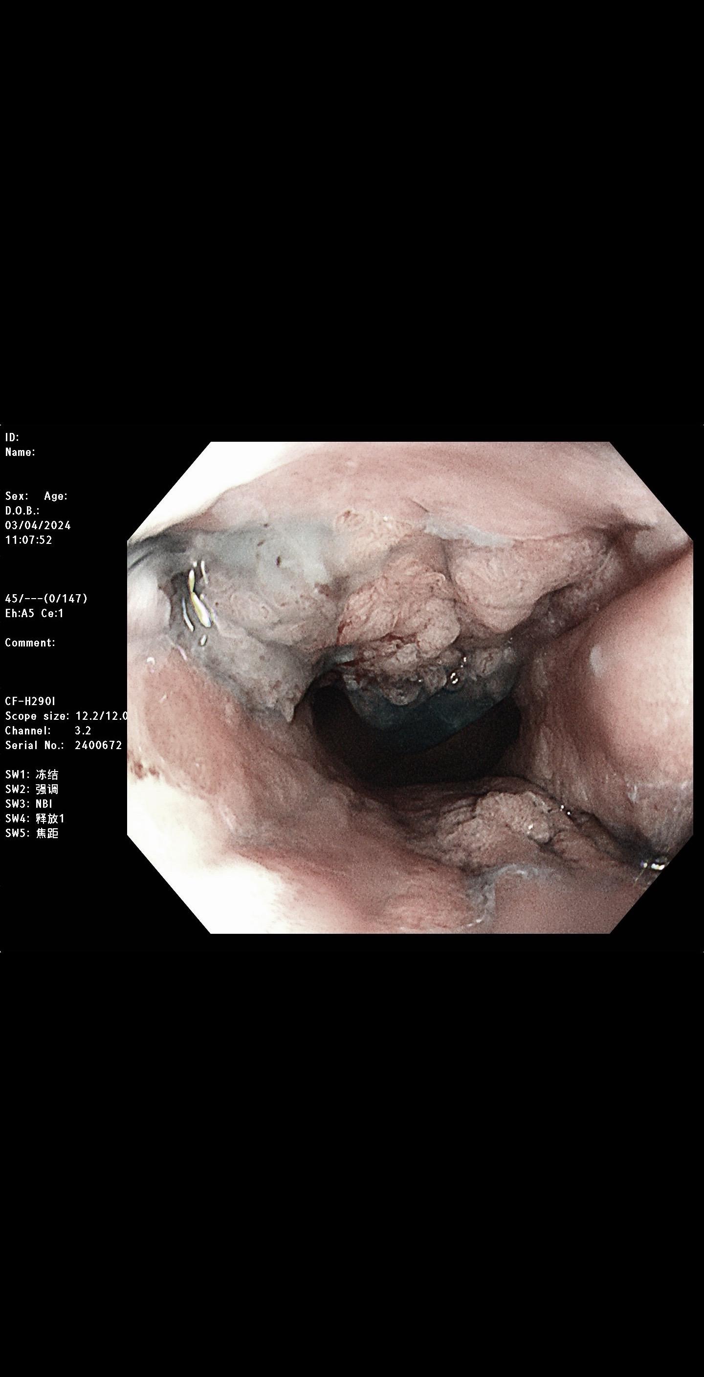 肛管乳头状管状腺Ca合并肛周Paget病。男，68岁，肛周瘙痒不适就诊，肛管见约2.0cm隆起型病变，表面呈绒毛样，附较多黏液，肛周皮肤见大片湿疹样皮损，肛肠科肛周皮肤活检提示中低分化腺Ca及Paget病(湿疹样癌Ca），行外科根治手术。
肛周Paget病是一种罕见的肛周区域上皮内腺Ca，属于乳腺外Paget病的一种类型。通常发生在老年人，没有明显的性别差异。最常见的症状是肛周顽固性瘙痒，局部应用皮质类固醇药物不能缓解。病变起初为肛周丘疹或鳞屑状红斑，逐渐扩展为浸润斑，形成溃疡，边缘高起，界限清楚。若累及肛