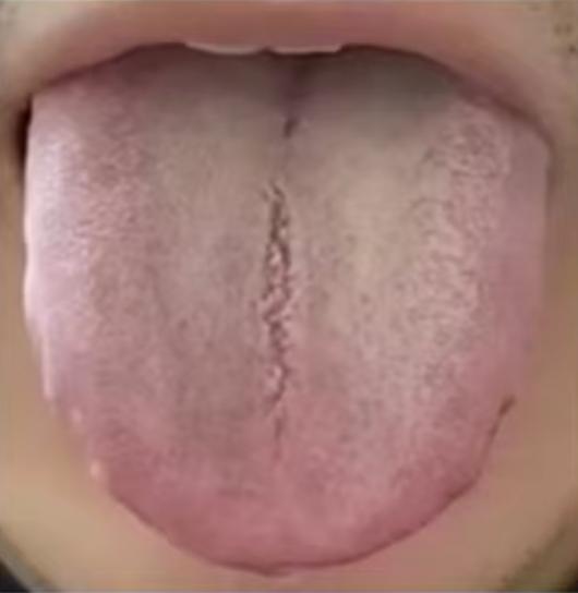 舌面中央有裂纹，舌头两侧有齿痕，此时该先补肾还是健脾？
 
今天结合门诊病例给大