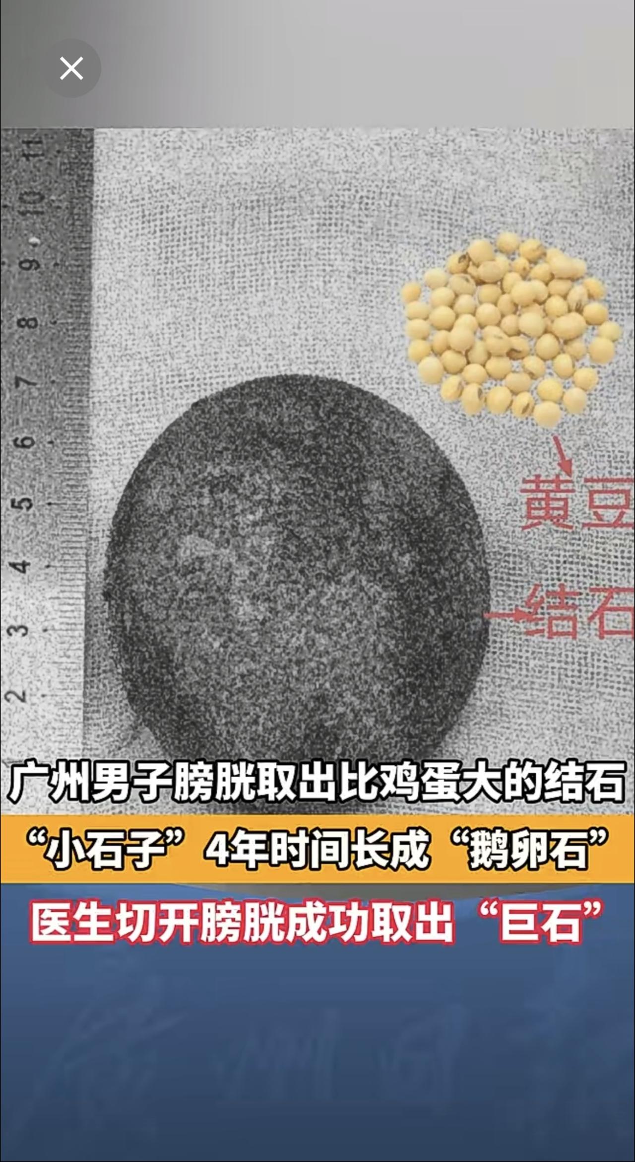 广州男子膀胱取出比鸡蛋大的结石 “小石子”4年时间长成“鹅卵石” 医生切开膀胱成