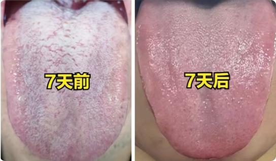 舌苔白腻别只补脾！分步调理七天见改善
看到舌苔又白又厚还油腻，多数人会第一时间想