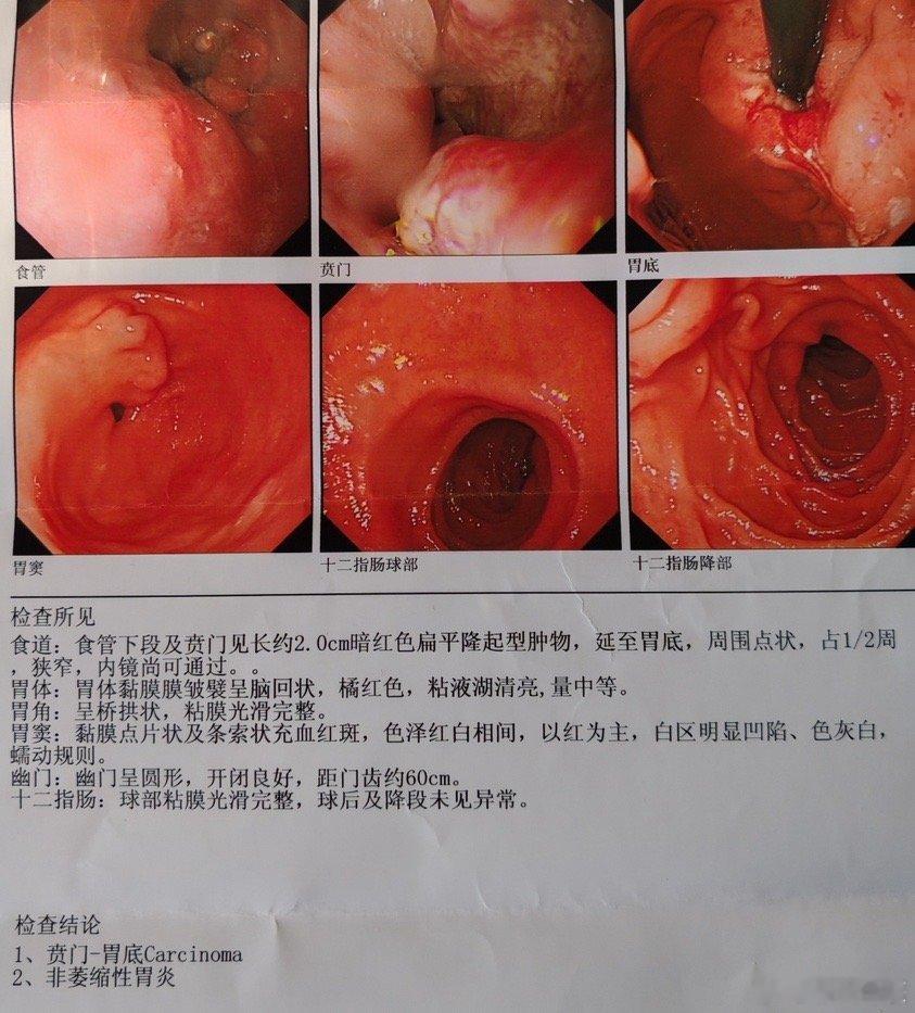 今早上收到一张胃镜结果，不太好。这个老爷子，去年12月底开始，断断续续找我看了两