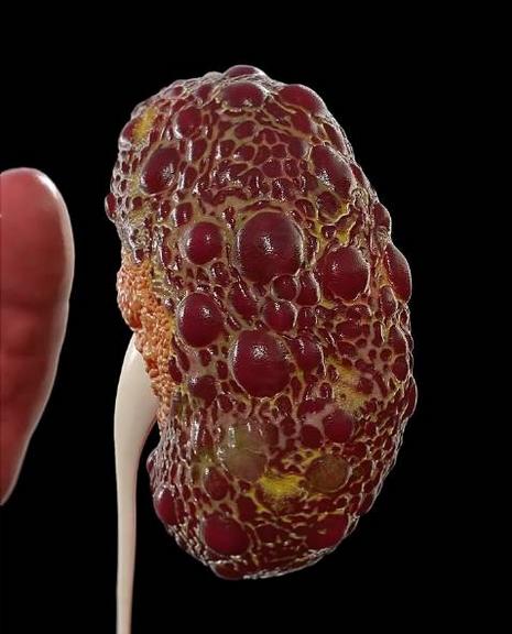 肾囊肿，把肾络淤堵清空，让气血滋养肾体，囊肿小了，肾也舒坦了！

你是否有过这样