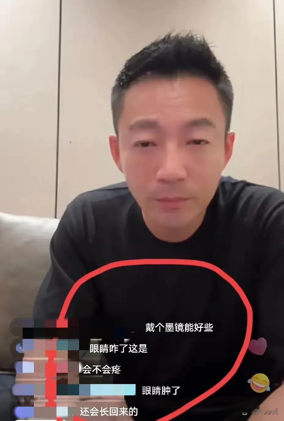 汪小菲这是咋啦
又受什么刺激了

昨晚汪小菲直播

一双眼睛肿得不行
有网友说他