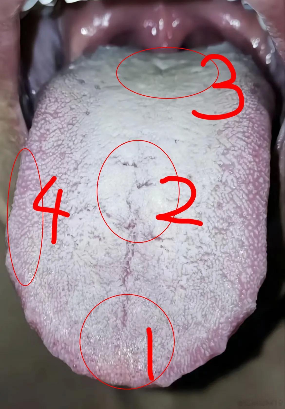 【粉丝舌苔分析：交粮快，腰膝酸软，腹胀痞满】1、舌尖凹陷扁薄白，有轻度裂纹。舌尖