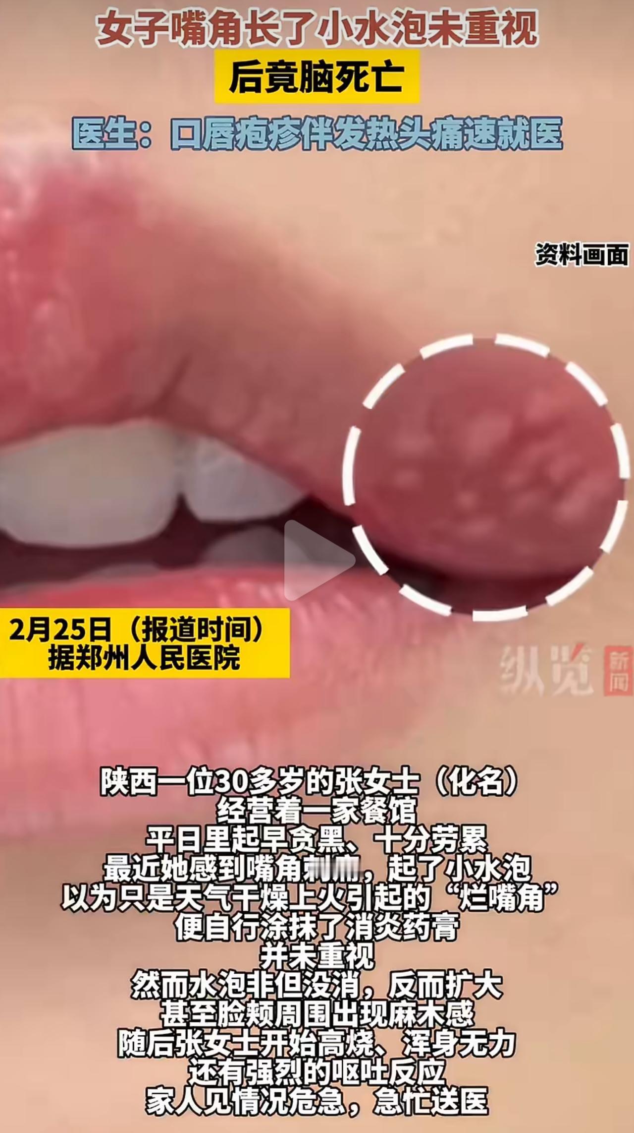 陕西一位30多岁的张女士，自己开餐饮店，天天忙得连休息时间都没有。那天嘴角疼，起