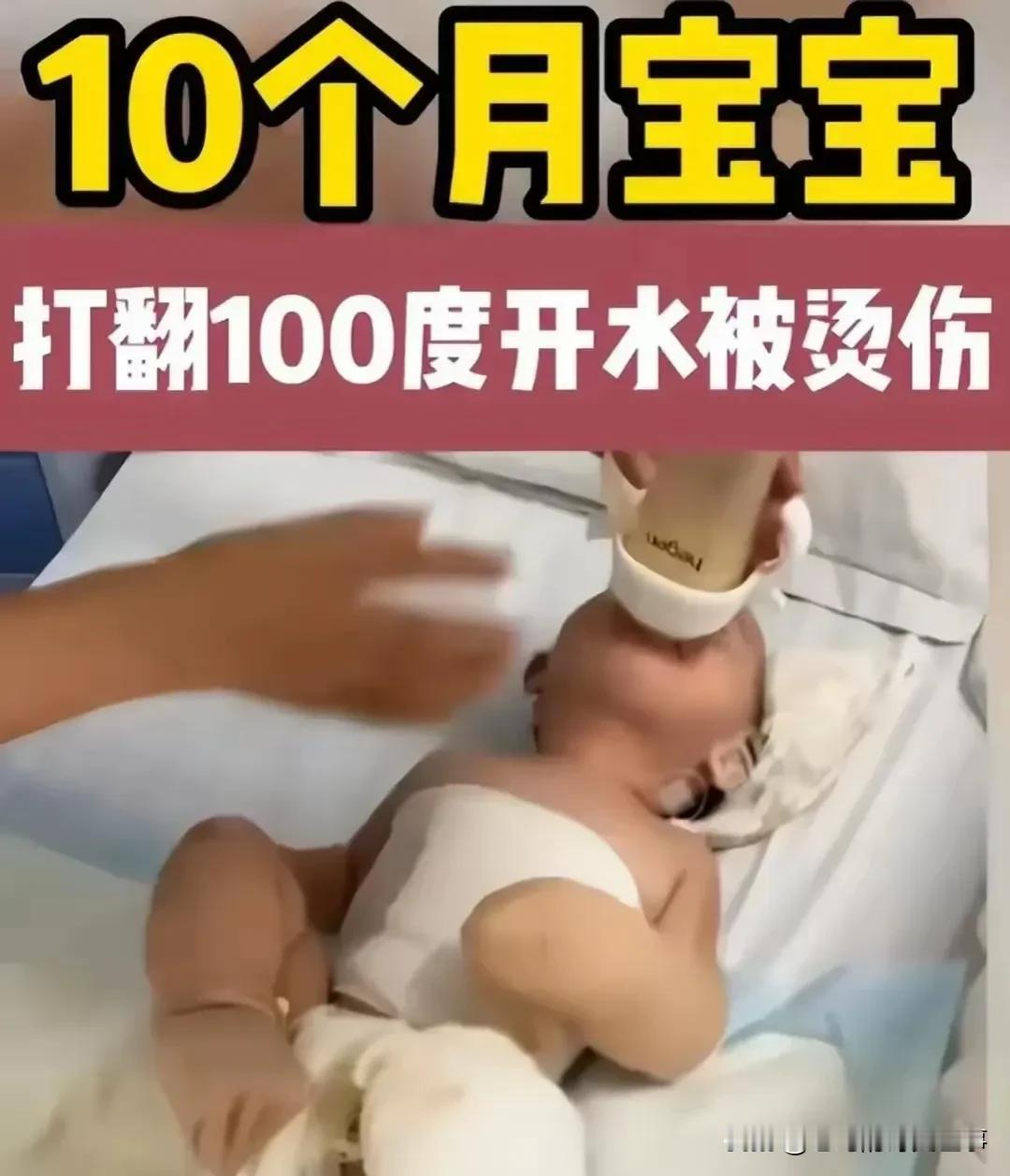 10个月宝宝打翻开水被严重烫伤！

才10个月大的宝宝，不幸打翻了开水，腹部和腿