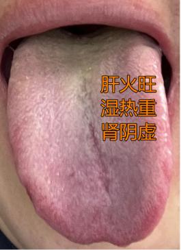 很经典的肝火旺、湿热重、肾阴虚的舌头，湿热已经化痰，所以调理时一定要先化痰！
 