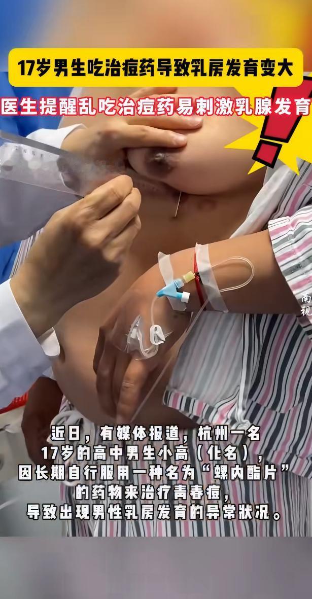 一则令人揪心的新闻引发关注：一名17岁男生因服用治痘药物，竟导致乳房发育变大。据