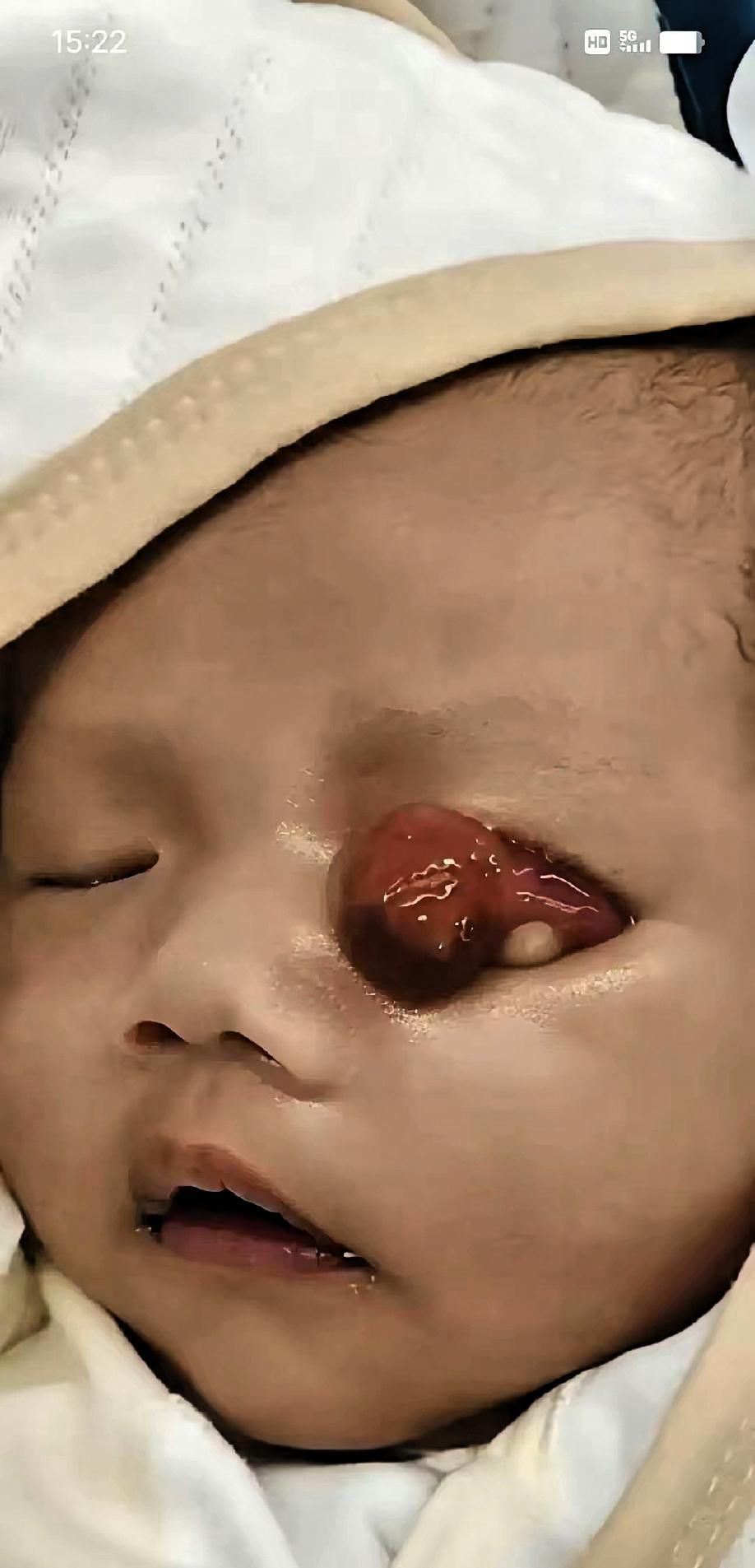 泪目！河南郑州，一家人在妇幼门口等着，娃刚落地，左眼皮上贴着一团肉，把眼睛压住了