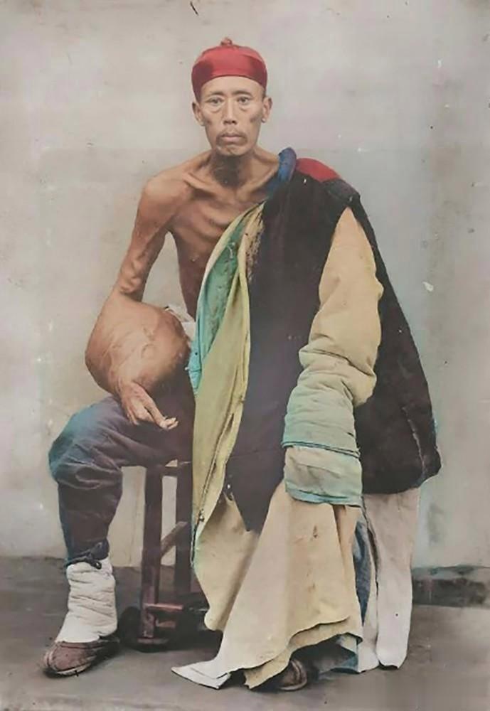 这是清朝时期，一名手上长了肿瘤的男子，这么大的肿瘤在男子瘦弱的体格衬托下，看起来
