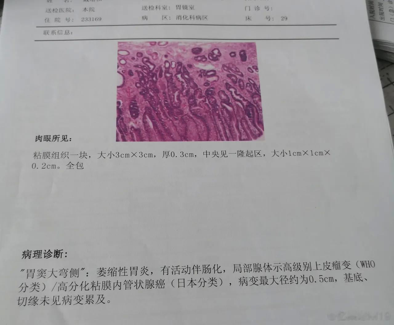 萎缩性胃炎，你需要知道的五个点​很多人一查出萎缩性胃炎，就很担心，主要因为它是一