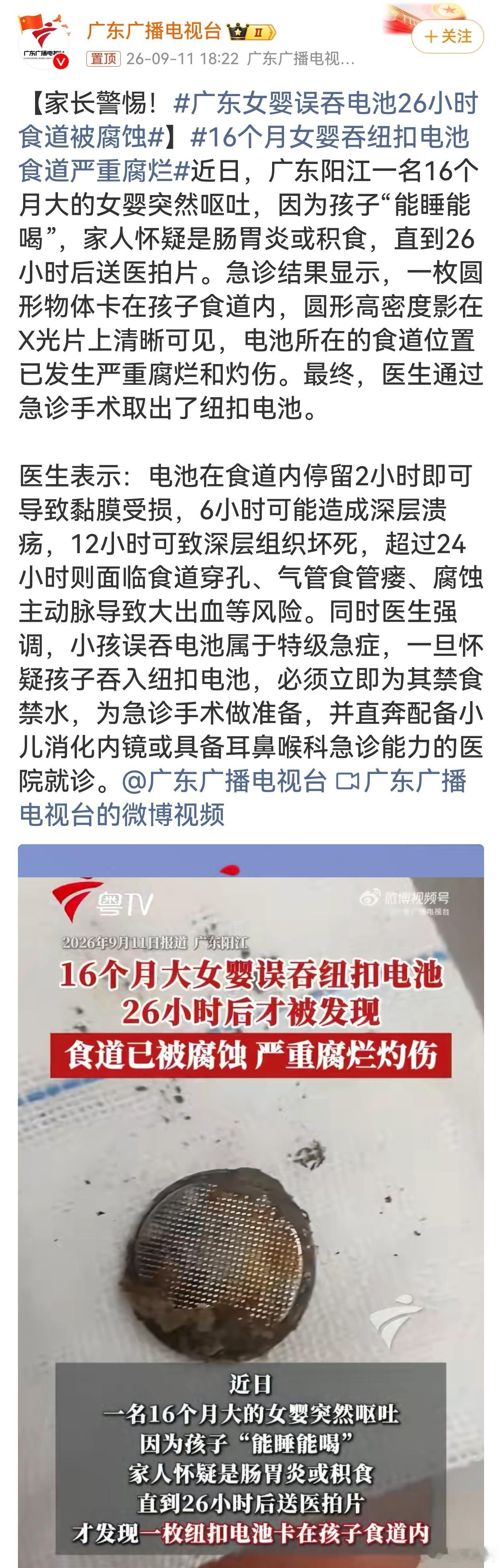 16个月女婴吞纽扣电池食道严重腐烂揪心案例！纽扣电池绝非普通异物，食道内滞留2小