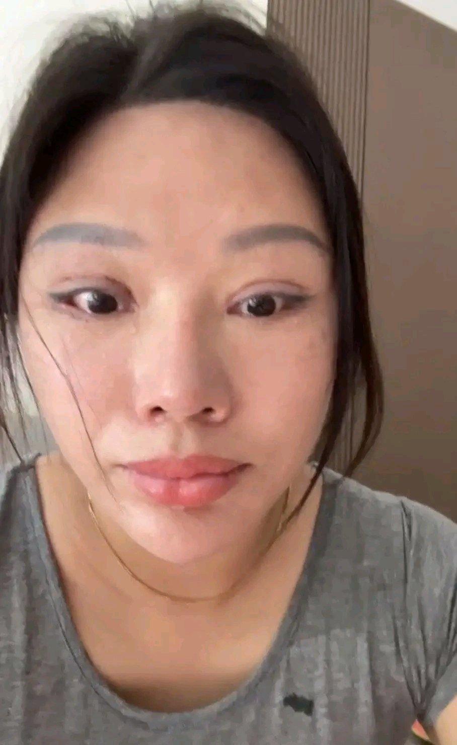 苏州女子王丽的整形遭遇简直太糟心了。5年前她去孟某芳的整形医院割双眼皮，术后眼睛