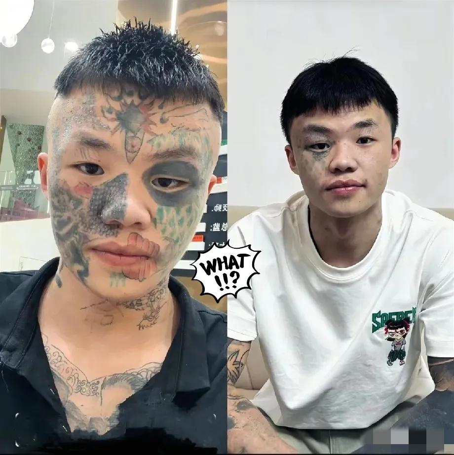 “后悔了吧？”

06年生的广东男孩夏朝勇，正咬着牙挨第五次激光洗纹身——三次下