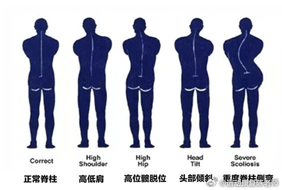 脊柱侧弯 继续来聊聊脊柱侧弯这个体态——青少年脊柱侧弯，可以早发现早干预，那成年
